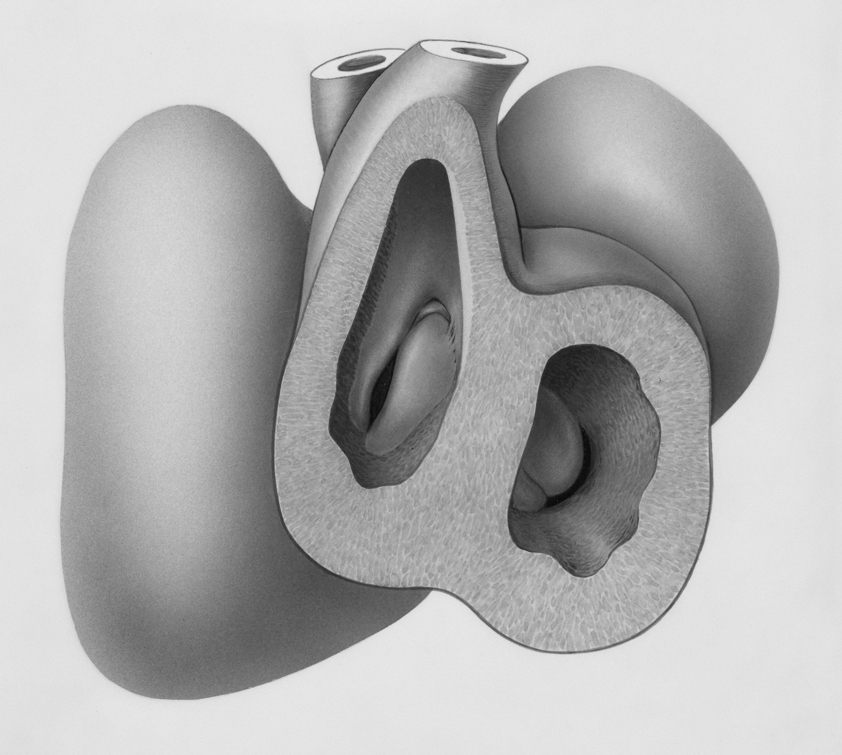 The Stuck Stapes: Otosclerosis and the Fixable Hearing Loss